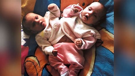 gabby garcia conjoined twin|I was a conjoined twin